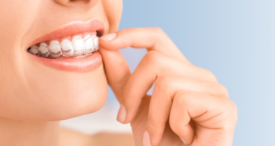Know About Invisalign Treatment | Tower House Dental Clinic